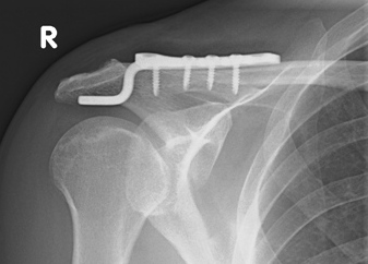 AC Luxation Typ Rockwood 3 nach Versorgung mit Balser Hakenplatte (Clavicular Hook Plate)